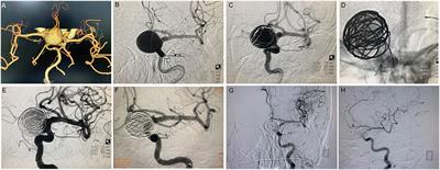 A multicenter retrospective controlled study of the Pipeline™ and Tubridge™ Flow Diverter devices for intracranial wide-necked aneurysms